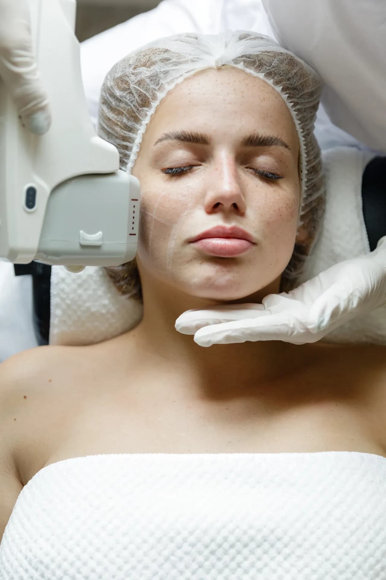 Face and neck SMAS lifting